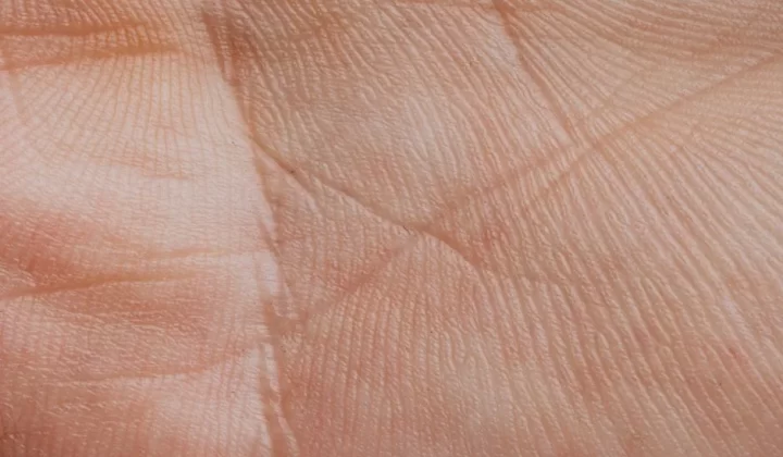 毛囊炎与痘痘区分示意图：皮肤纹理与护理判断