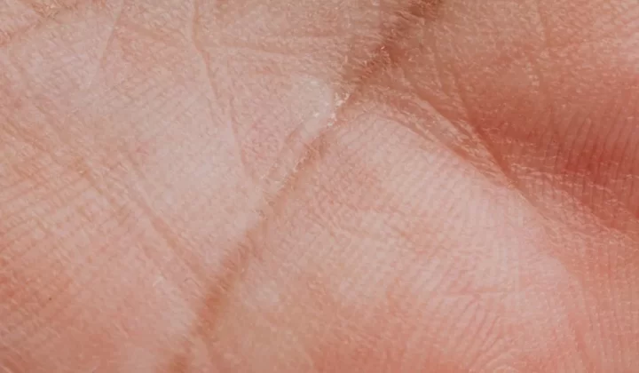 痤疮毛囊炎分类示意图：皮肤质地判断