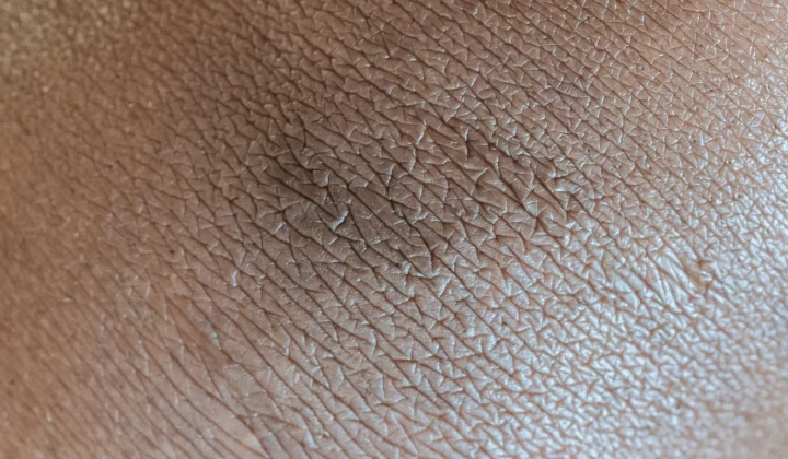 皮肤粗糙一粒粒判断