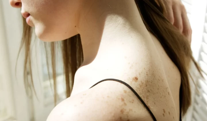 阳光下女性有雀斑的肩膀特写