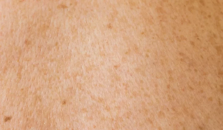 a close up of a person's back with brown spots