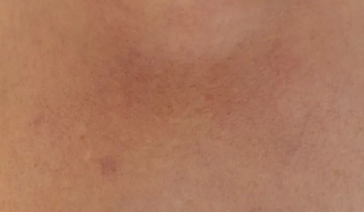 a close up of a person's back with acne on it
