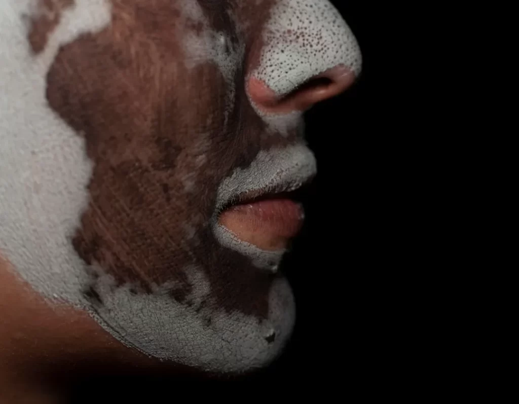 A face mask covers parts of the skin.